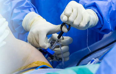 Shoulder Arthroscopy (Rotator Cuff, Instability)
