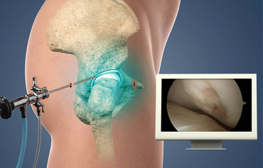 Hip Arthroscopy