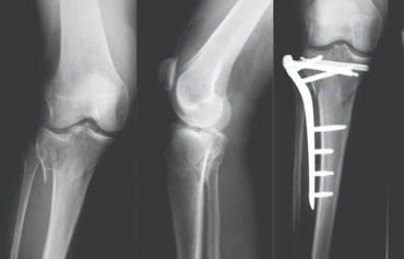 Minimally Invasive Fracture Fixation